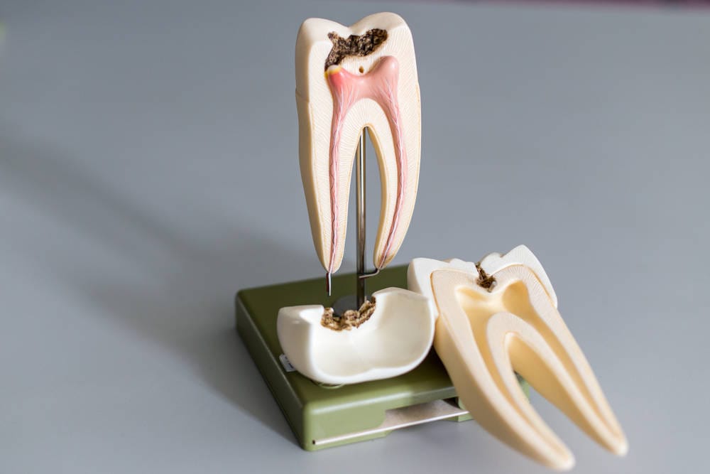Root canal treatment chermside